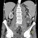 Renal carcinoma, cystic, retroperitoneal lymphadenopathy: CT - Computed tomography